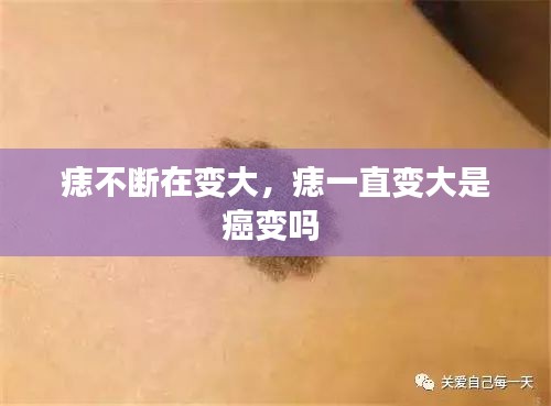 痣不断在变大，痣一直变大是癌变吗 